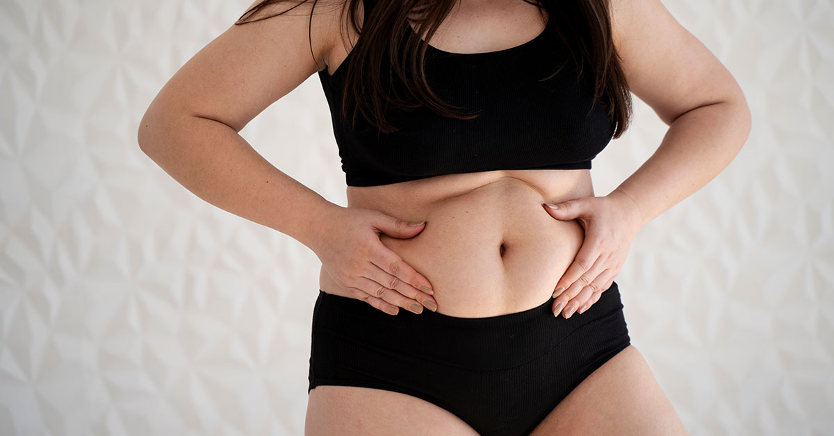 diástasis abdominal