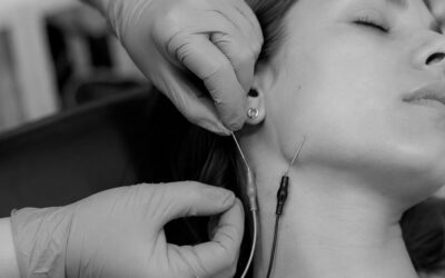 Electropunción ATM en Zaragoza para tratar bruxismo y dolor mandibular